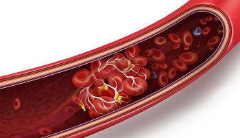 Blood clot in a blood vessel