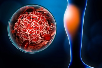 leg dvt