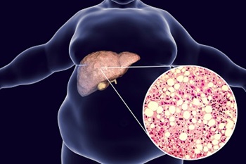 illustation of fatty liver