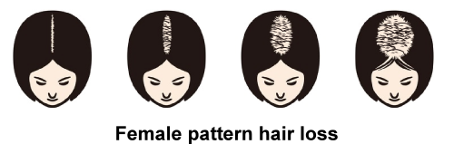 illustration of female pattern hair loss