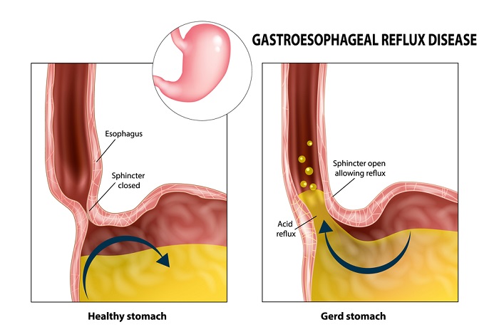 gerd mechanism illustration