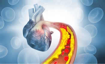 Illustration related to high cholesterol