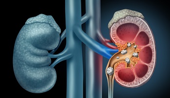 Illustration of kidney with a stone