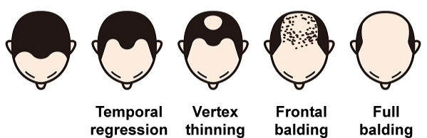 illustration of male pattern hair loss