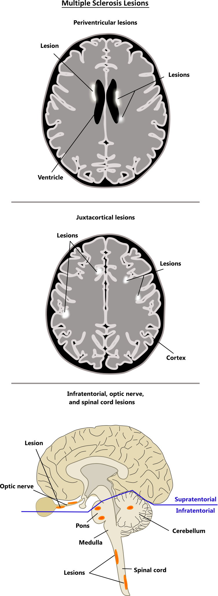 Multiple Sclerosis Crisis Worksheet