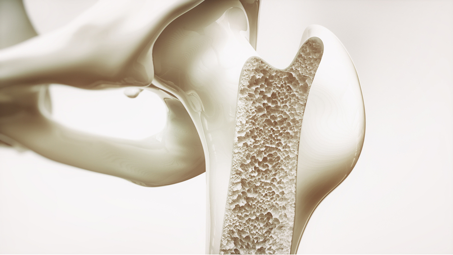 hip bone with osteoporosis