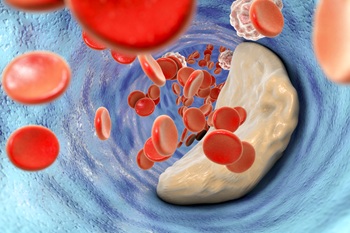 platelets and clot in artery