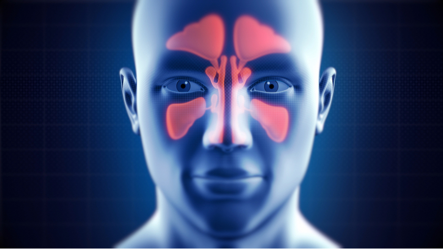Sinusitis sinusitis
