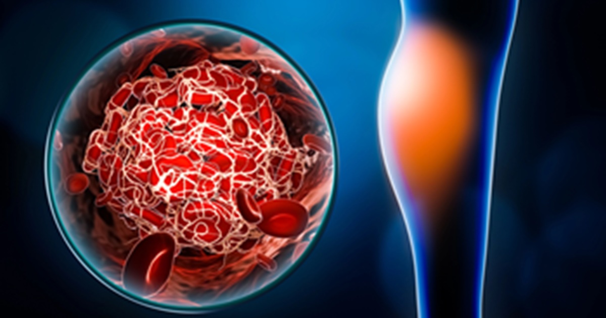 Deep vein thrombosis illustration