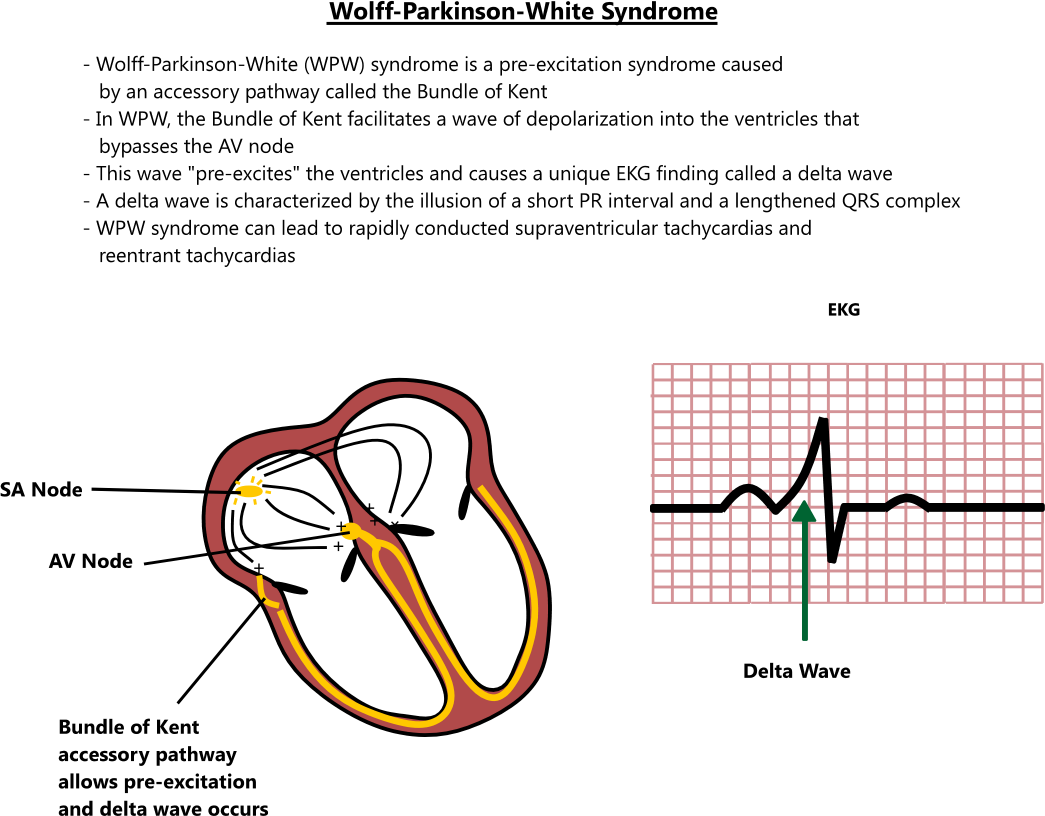 Wolff-Parkinson-White syndrome illustration - EroFound